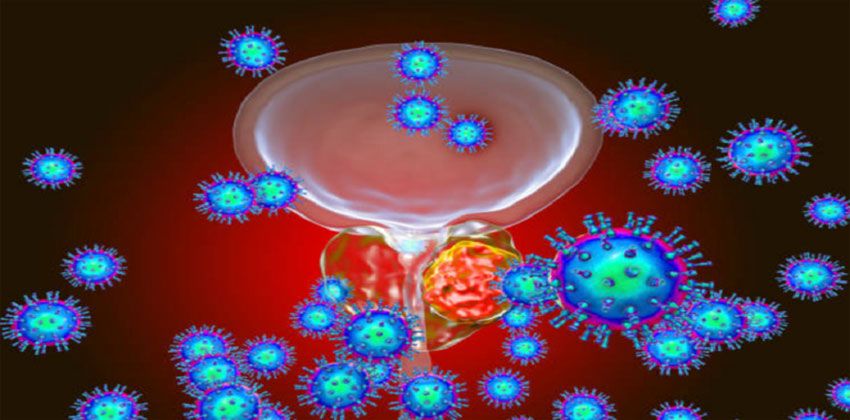 سرطان البروستات