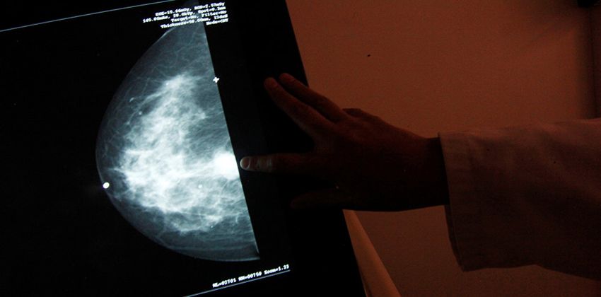 سرطان الثدي