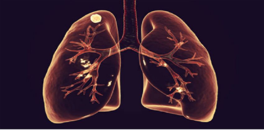 سرطان الرئة