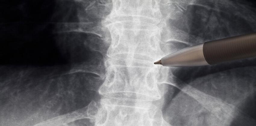 علاج الشلل